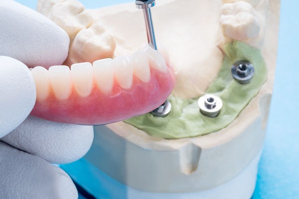 Essential Things To Know About All On   Dental Implants